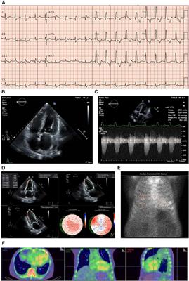 A wolf in sheep's clothing—aortic stenosis and cardiac amyloidosis: “RAISE”ing awareness in clinical practice